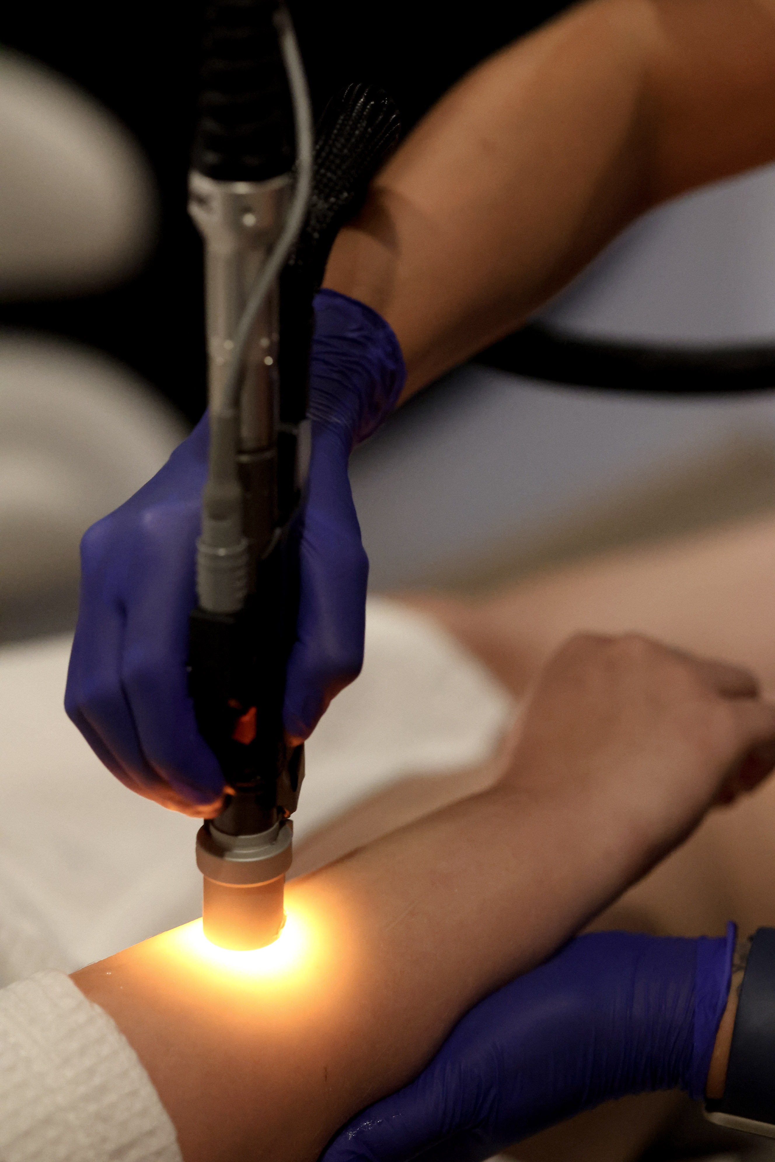 Advanced laser skin treatment